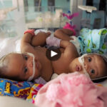 Astounding Triumph: Conjoined Twins Successfully Split, Captivating the Internet.